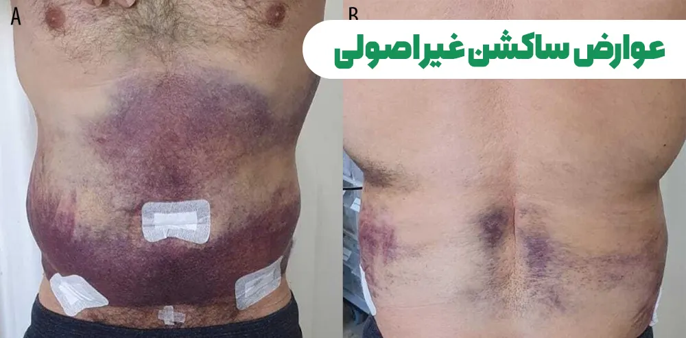 معایب ساکشن شکم و پهلو