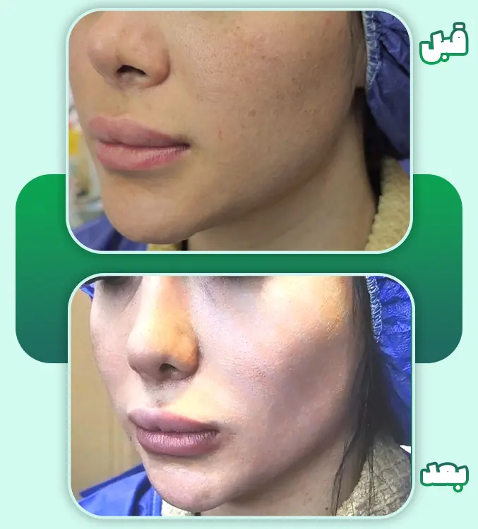 قبل و بعد بوکال فت