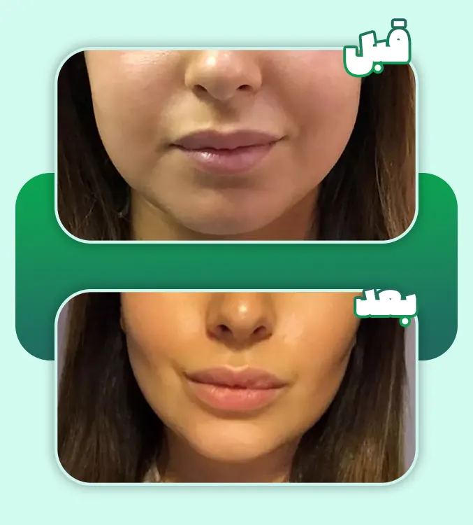 قبل و بعد بوکال فت