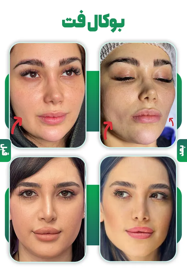 قبل و بعد بوکال فت