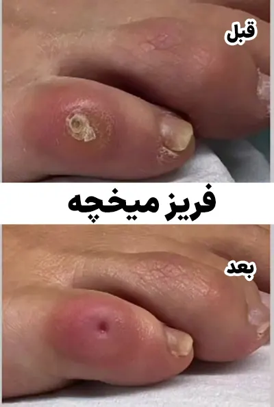 قبل بعد فریز میخچه