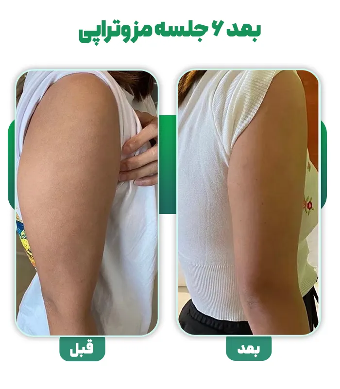 قبل بعد مزو چربی سوز