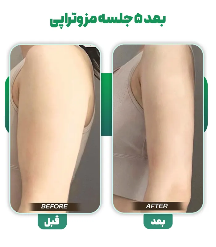 قبل بعد مزو چربی سوز