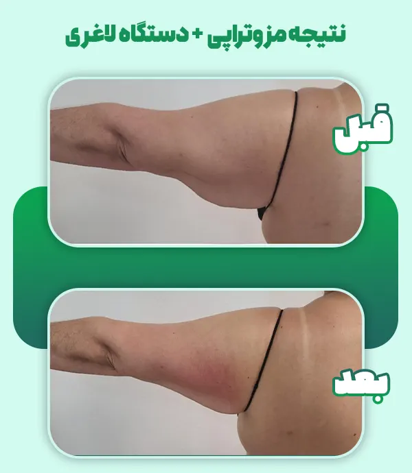 قبل بعد مزو چربی سوز