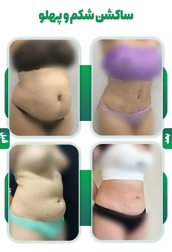 قبل و بعد ساکشن شکم