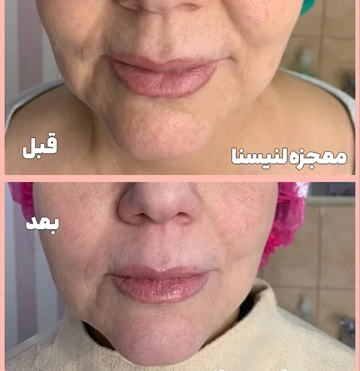 قبل و بعد لنیسنا