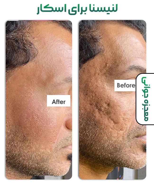 لنیسنا برای اسکار