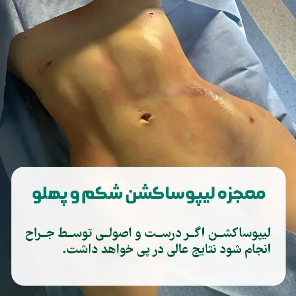 لیپوساکشن شکم