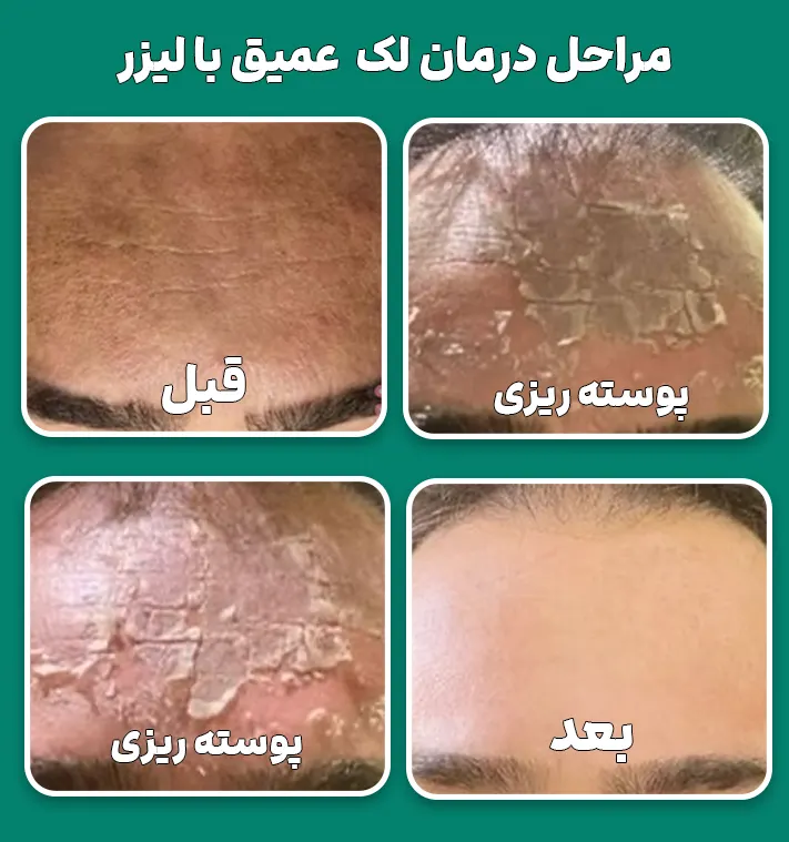 مراحل درمان لک عمیق با لیزر