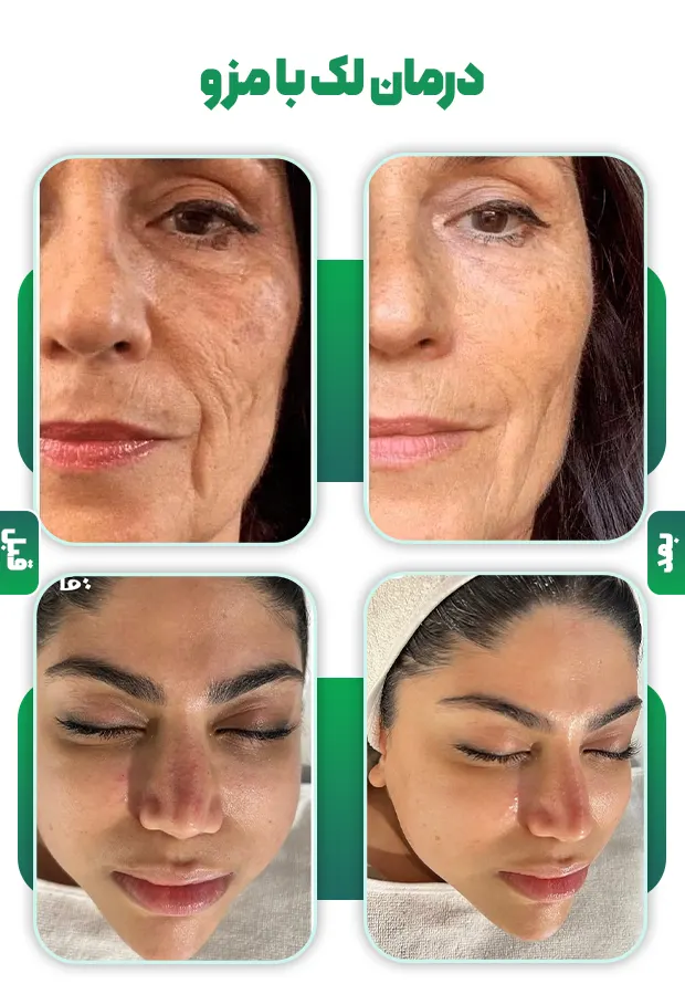 درمان لک با مزوتراپی