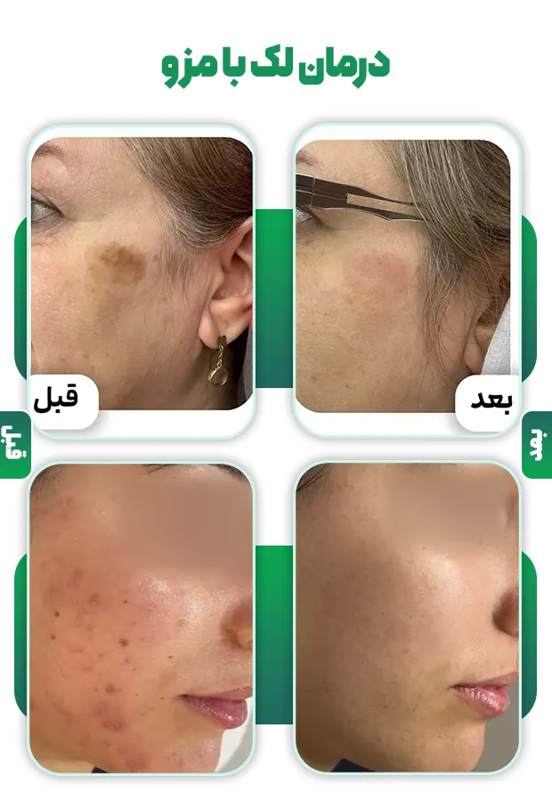 درمان لک با مزوتراپی