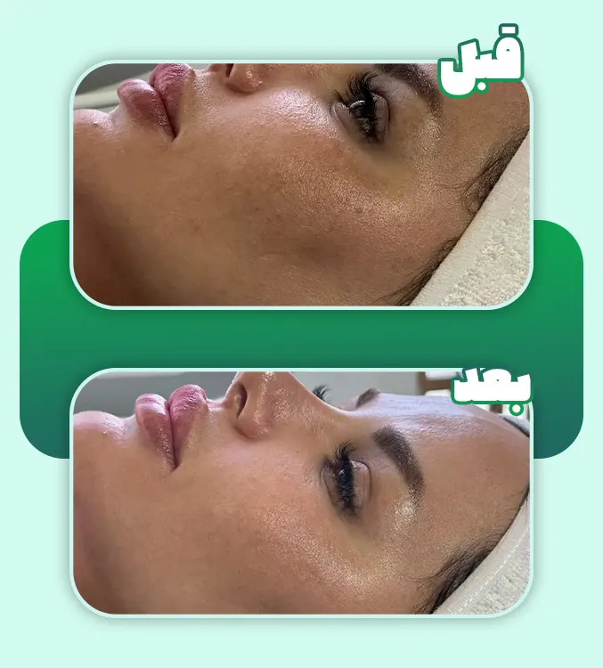 درمان لک با مزوتراپی