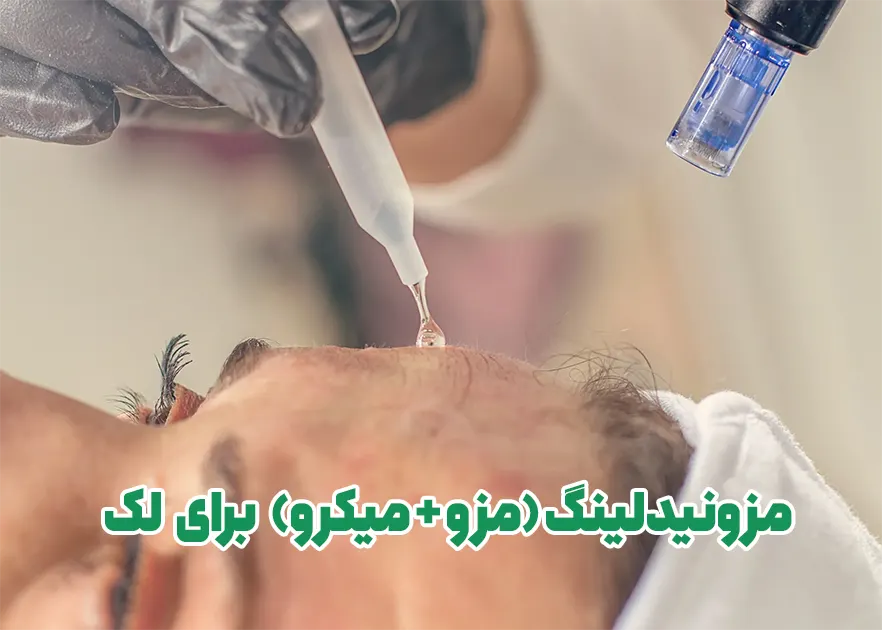 مزونیدلینگ لک