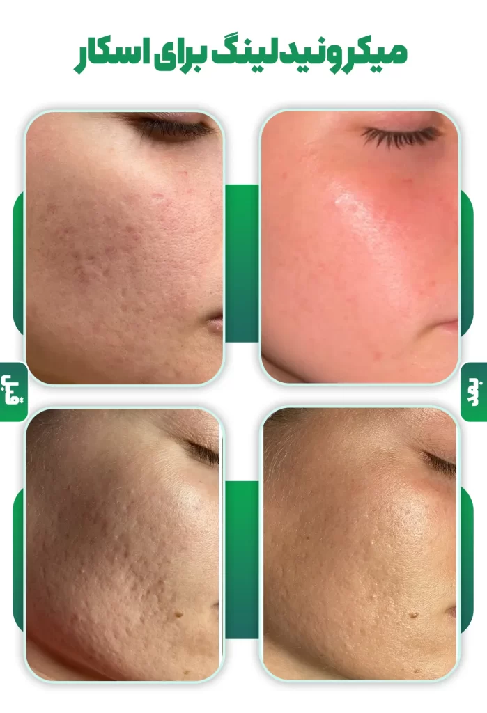 میکرونیدلینگ برای اسکار