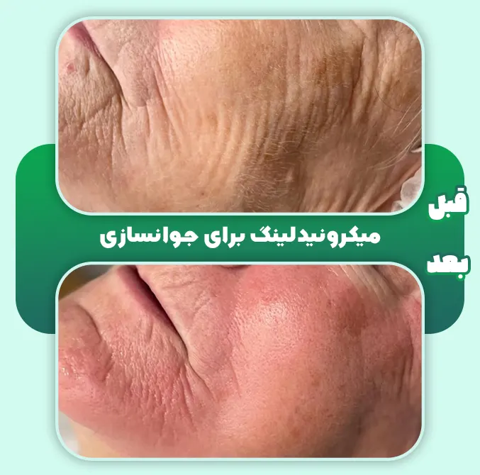 میکرونیدلینگ برای جوانسازی