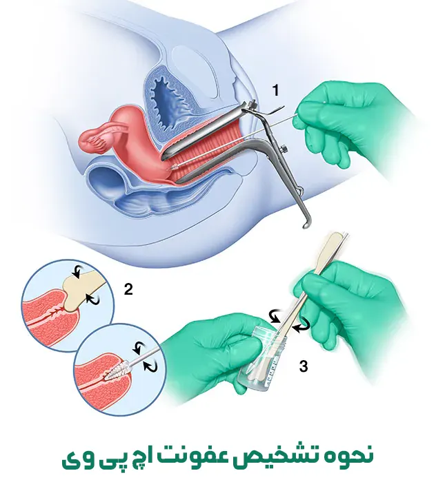 نحوه تشخیص عفونت اچ پی وی