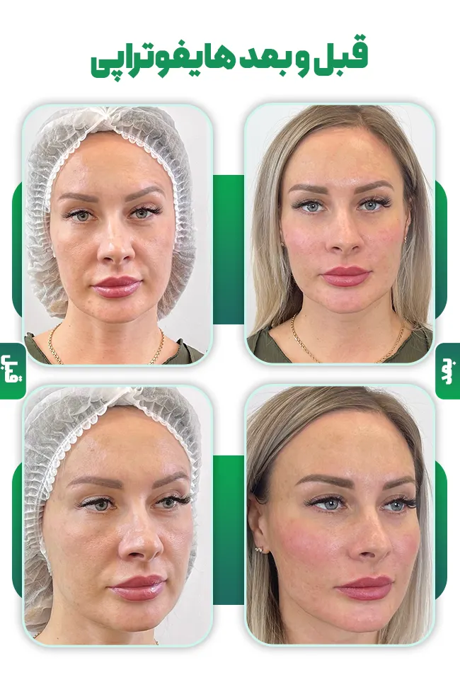 قبل و بعد هایفوتراپی صورت