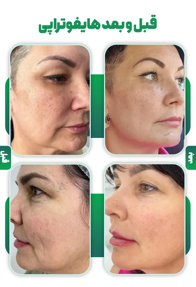 قبل و بعد هایفوتراپی صورت