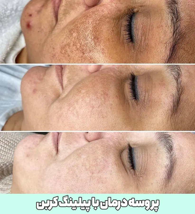 پیلینگ کربن