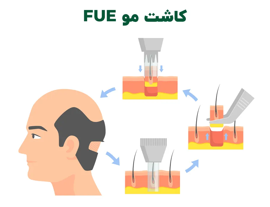 کاشت مو FUE