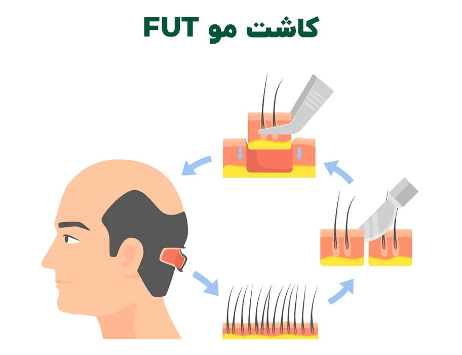 کاشت مو fut