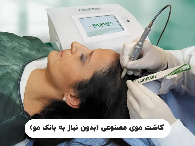 کاشت موی مصنوعی بدون نیاز به بانک