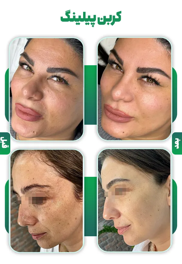 قبل و بعد کربن پیلینگ با لیزر