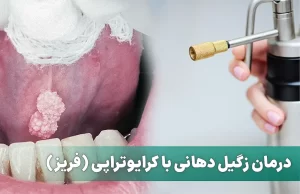 درمان زگیل دهانی با کرایوتراپی