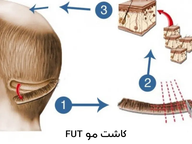 کاشت مو به روش FUT