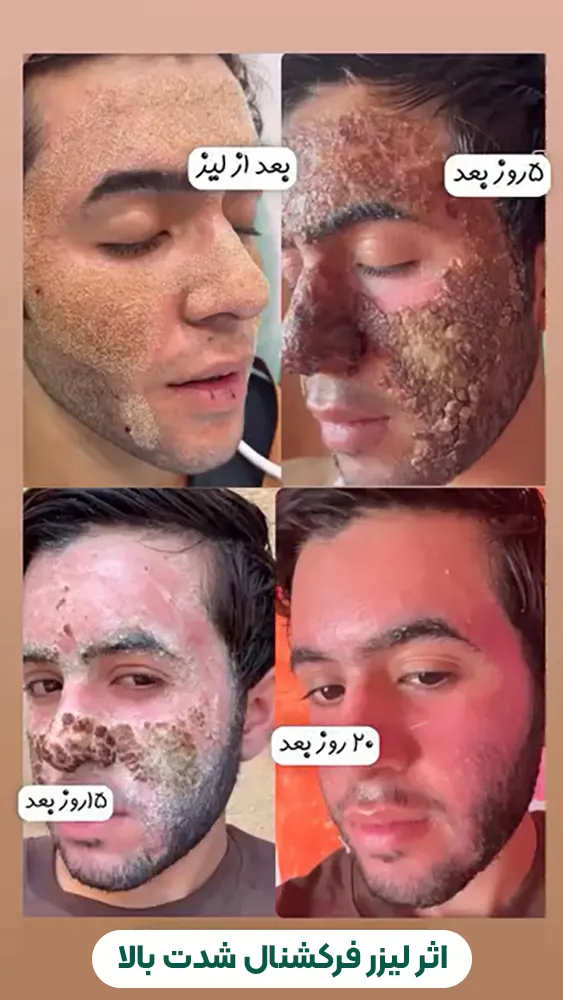 اثر لیزر فرکشنال