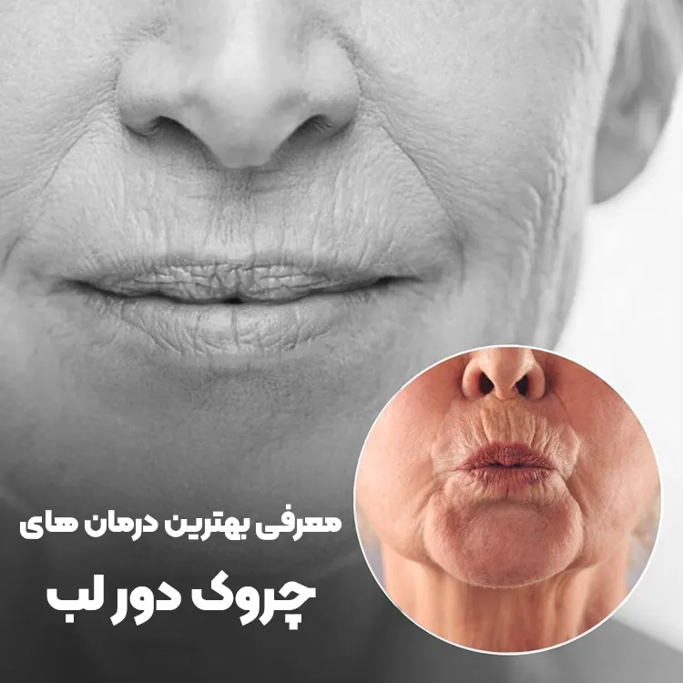 بهترین درمان چروک دور لب