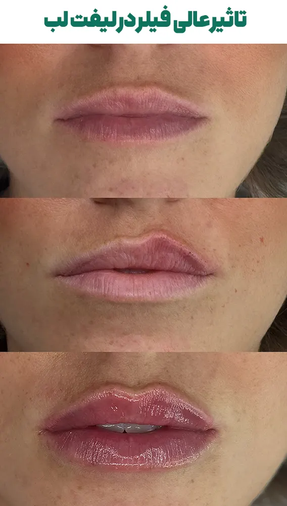 تاثیر عالی فیلر در لیفت لب