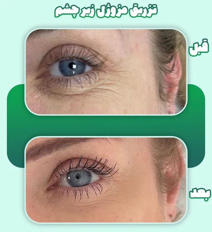 تزریق مزوژل زیر چشم قبل بعد