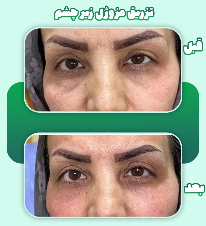 تزریق مزوژل زیر چشم قبل بعد