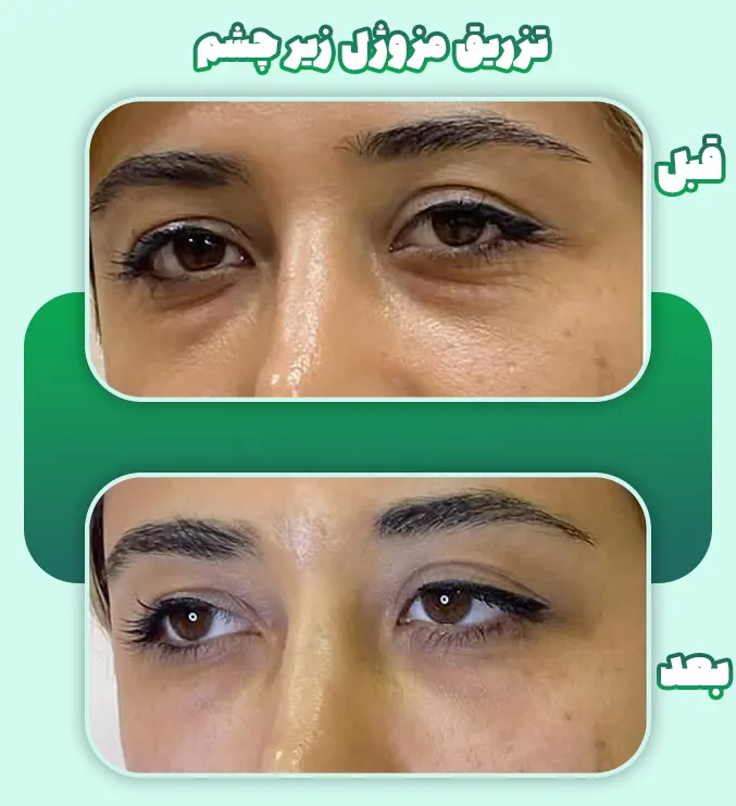 تزریق مزوژل زیر چشم قبل بعد