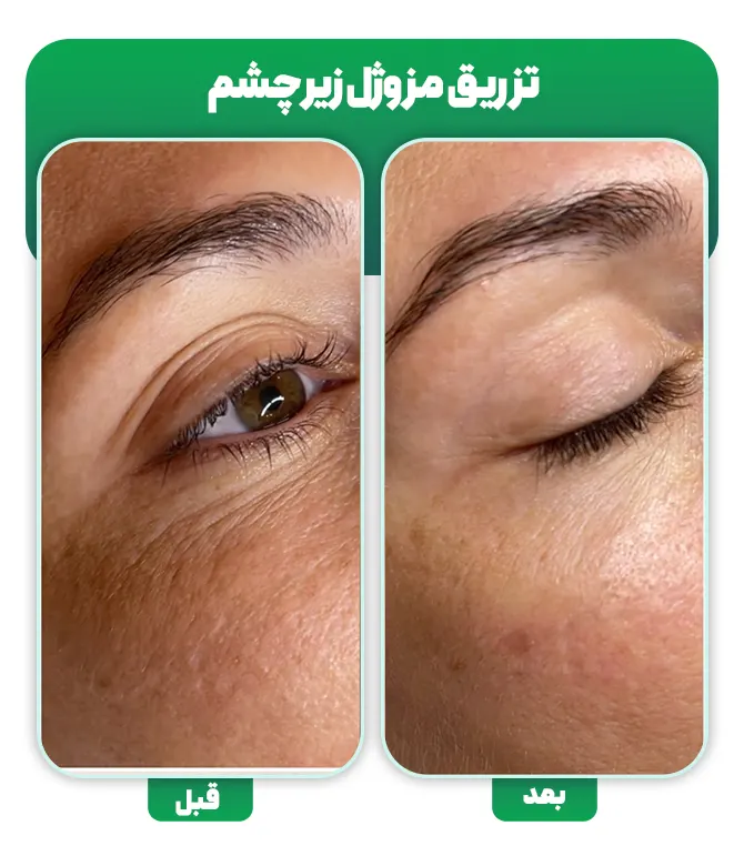 تزریق مزوژل زیر چشم قبل بعد