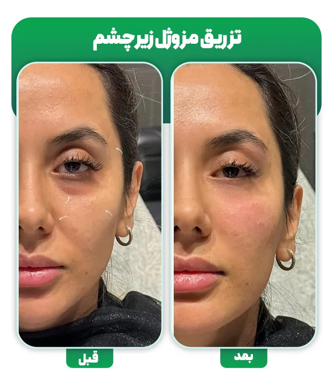 تزریق مزوژل زیر چشم قبل بعد