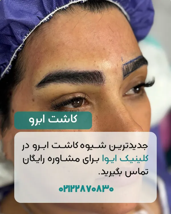 کاشت ابرو در ایوا