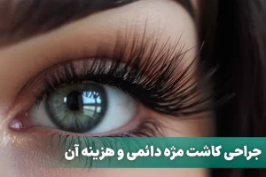 جراحی کاشت مژه دائمی و هزینه آن