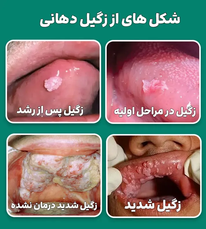 درجه بندی زگیل دهانی