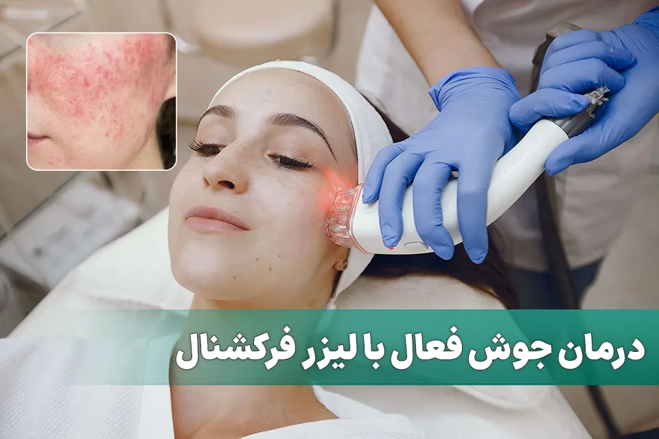 درمان جوش فعال با لیزر فرکشنال