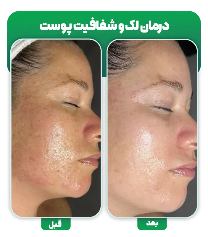درمان کدری پوست قبل و بعد