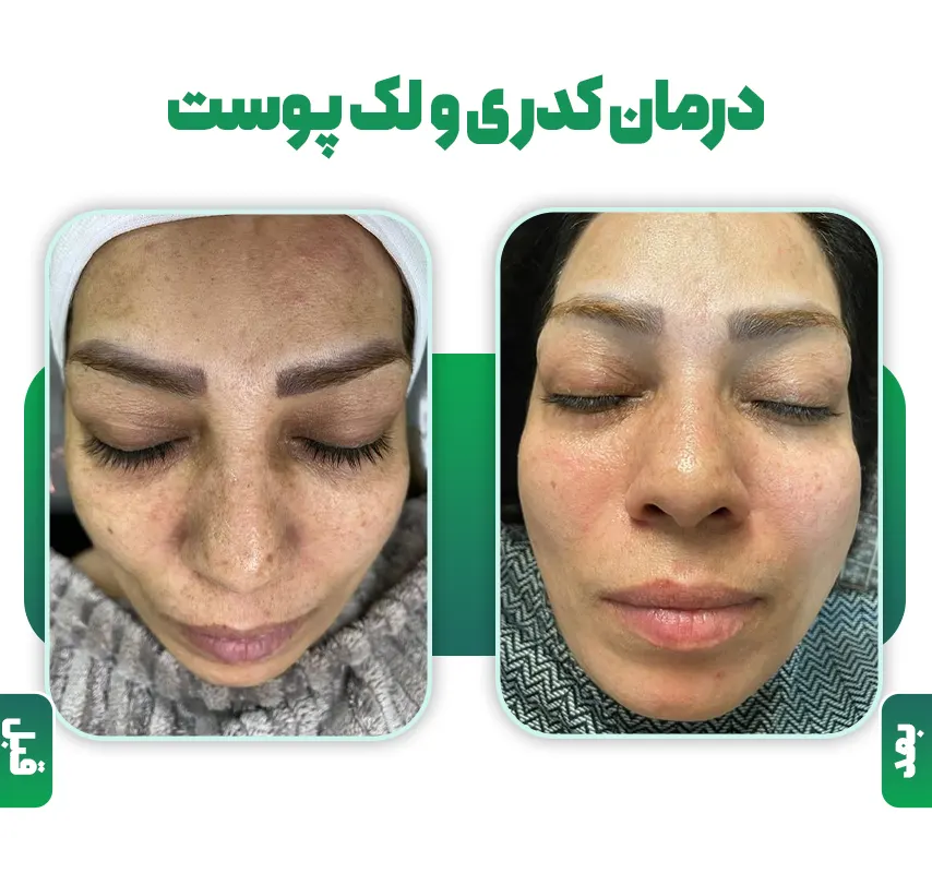 درمان کدری پوست قبل و بعد