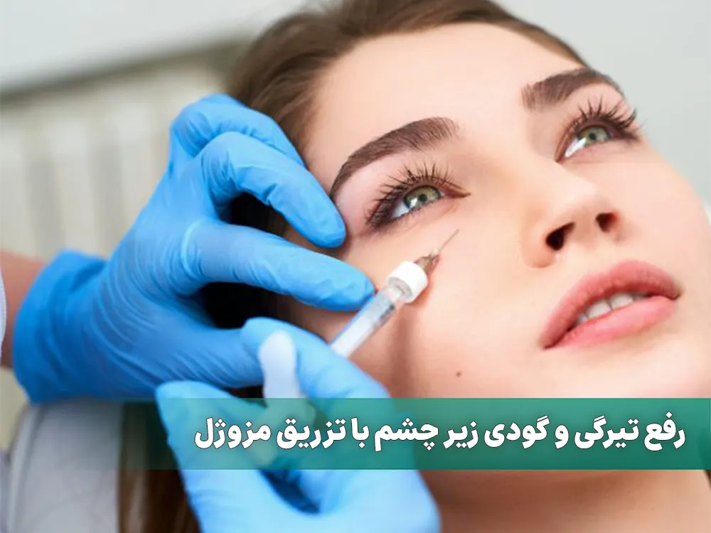 مزوژل زیر چشم