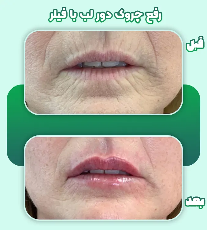 رفع چروک دور لب با فیلر