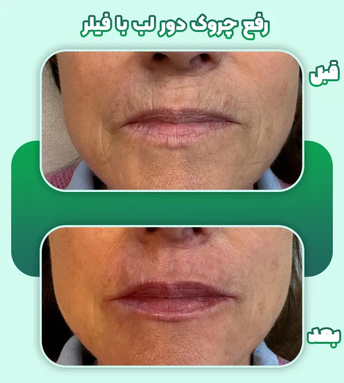 رفع چروک دور لب با فیلر