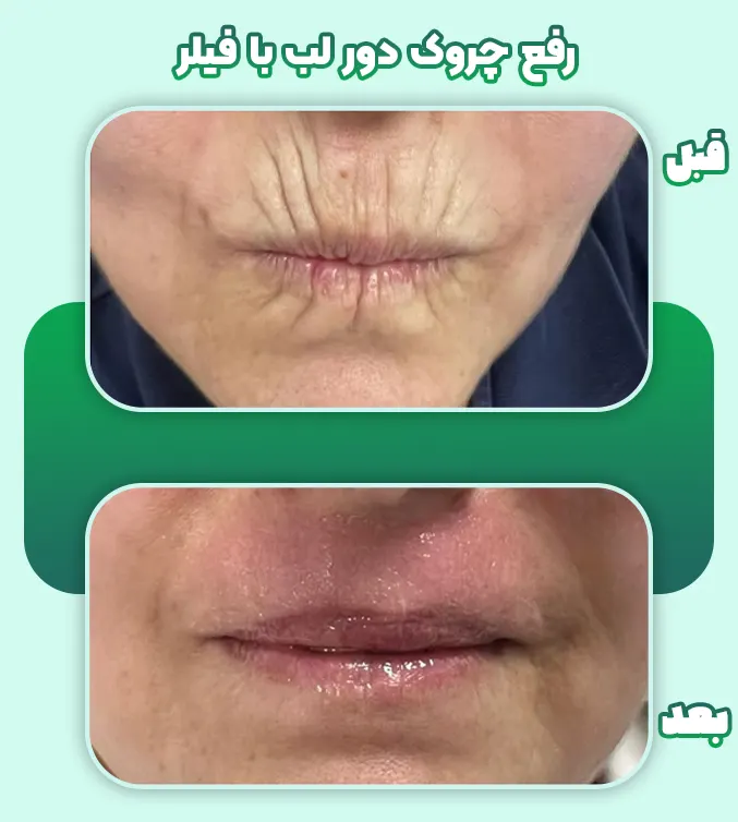 رفع چروک دور لب با فیلر