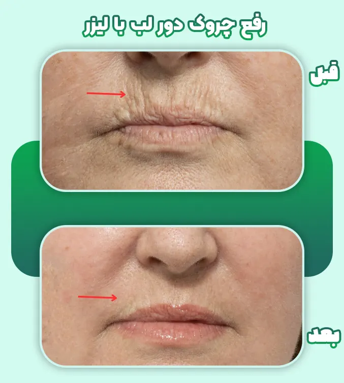 رفع چروک دور لب با لیزر