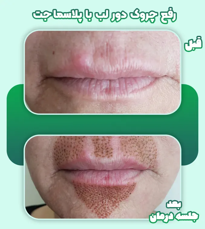 رفع چروک دور لب با پلاسما جت