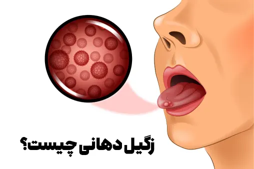 زگیل دهانی چیست